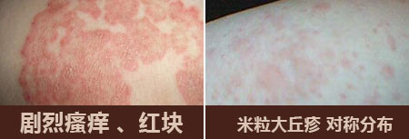 南京肤康皮肤医院毛囊炎对人体的危害有哪些