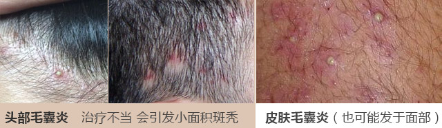 南京肤康皮肤医院穿掘性毛囊炎不及时治疗有什么危害