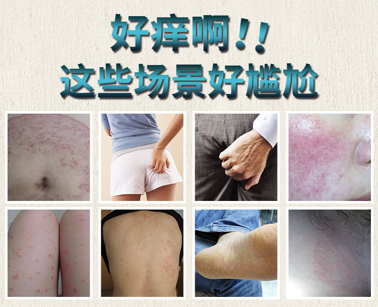 南京肤康皮肤医院：体癣发病后有哪些症状？