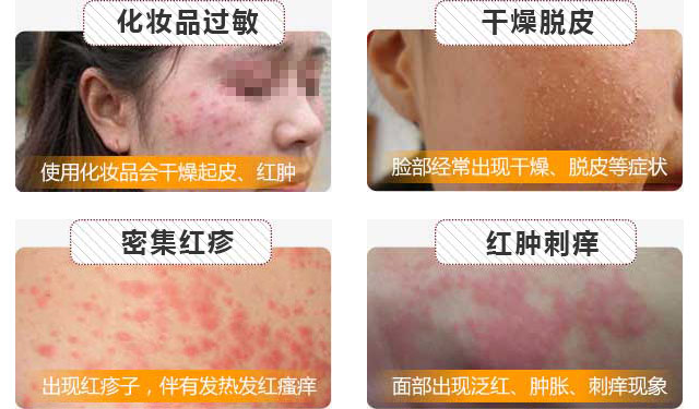  南京肤康皮肤医院外阴湿疹的症状有哪些？