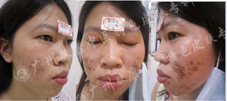 南京肤康皮肤医院经常摸脸会引起痤疮疾病的出现吗？