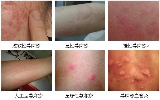 南京肤康皮肤医院认清湿疹的3种类型