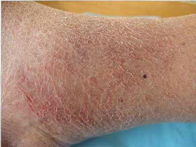 南京湿疹难治疗的原因是什么呢