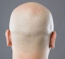南京肤康皮肤科医院，年轻人脱发的多见原因有哪些？