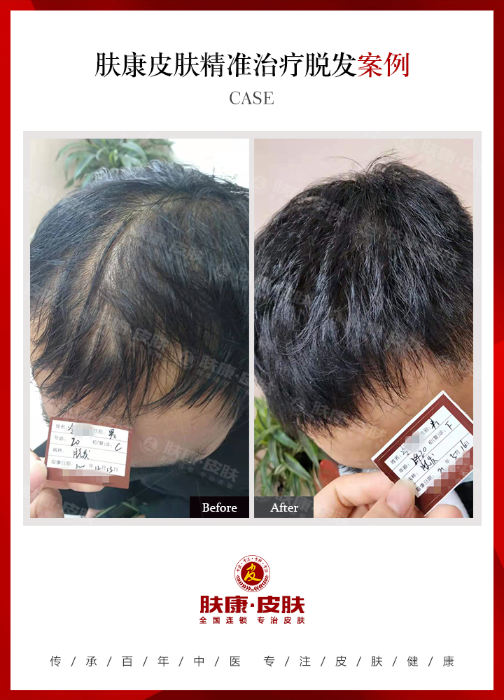  南京肤康皮肤医院合理治疗脱发很重要