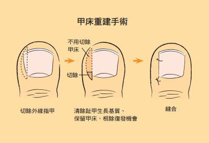 南京肤康皮肤医院甲沟炎的不同类型症状？
